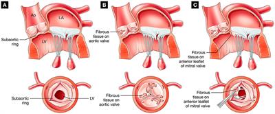 Discrete Subaortic Stenosis: Perspective Roadmap to a Complex Disease